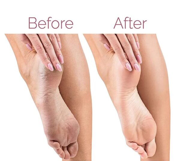 Professional Callus Remover