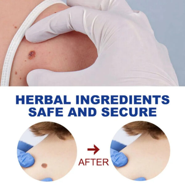 Quick Wart Removal Pen