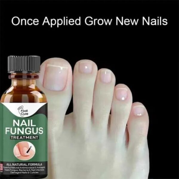 Nail Fungus Treatment 10ml